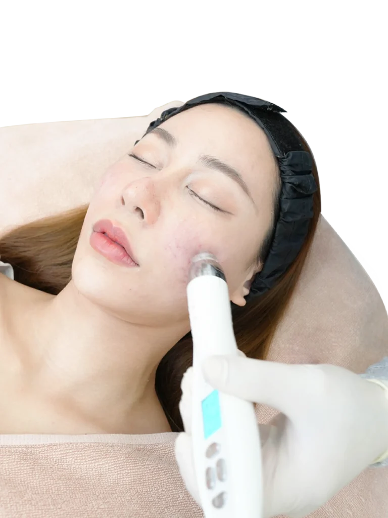 กำจัดสิว