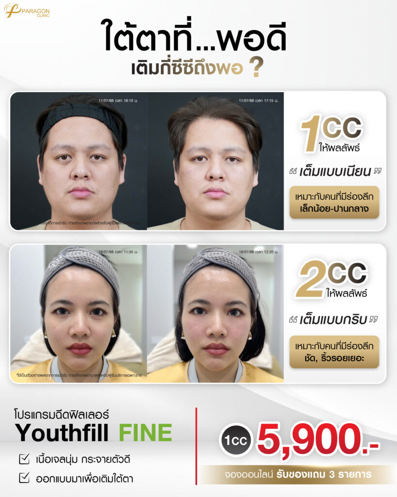 แพ็กเกจฟิลเลอร์ + โบท็อก ลด 36%