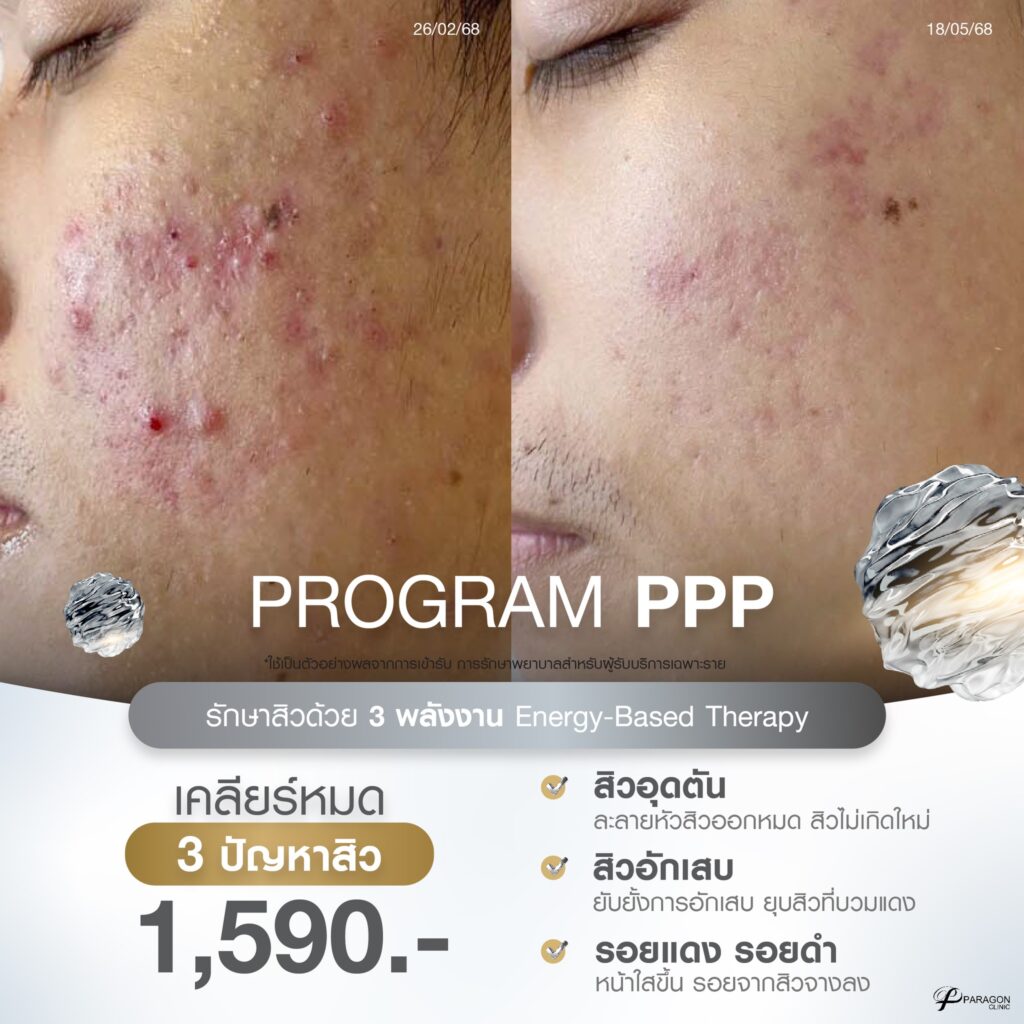 Young Reset+ ลด 28%