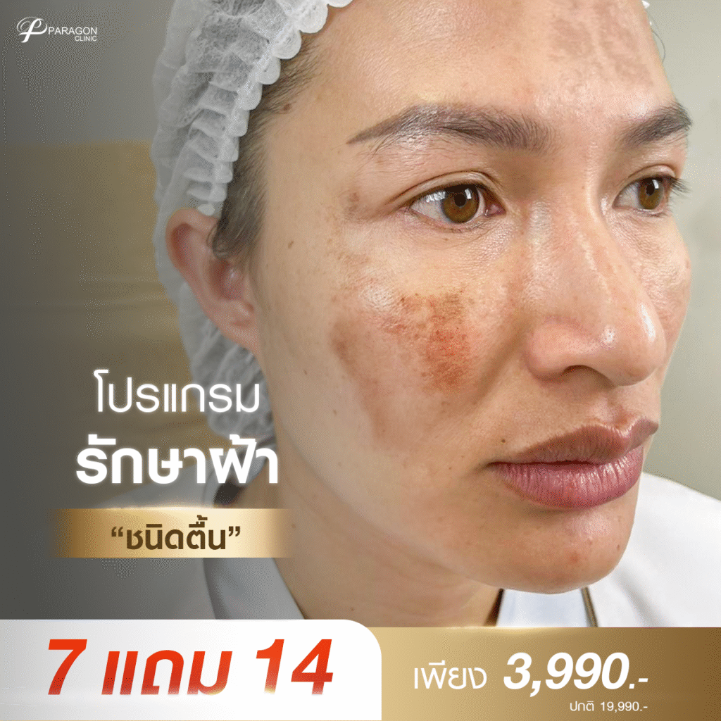 Ultherapy ยกกระชับ ลด 33%